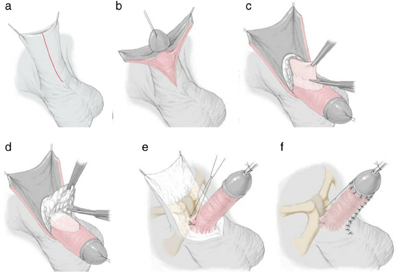 ligamentotomy барои васеъ кардани penis